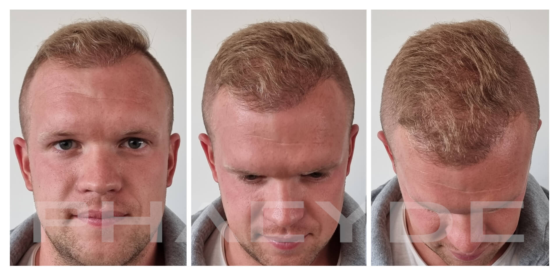 Patrik 7 Months After Hair Transplantation