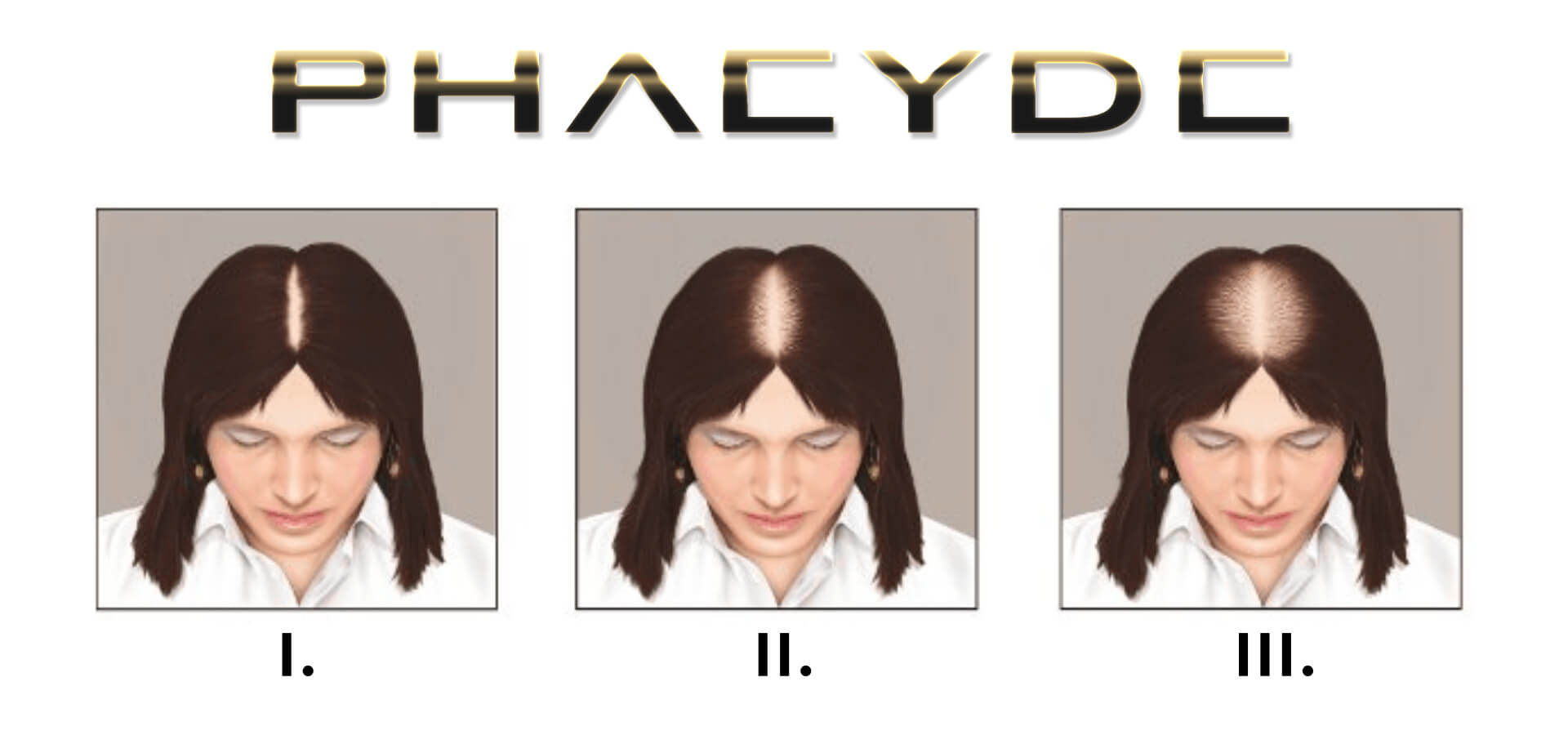 Skala Ludwiga: Etapy utraty włosów u kobiet