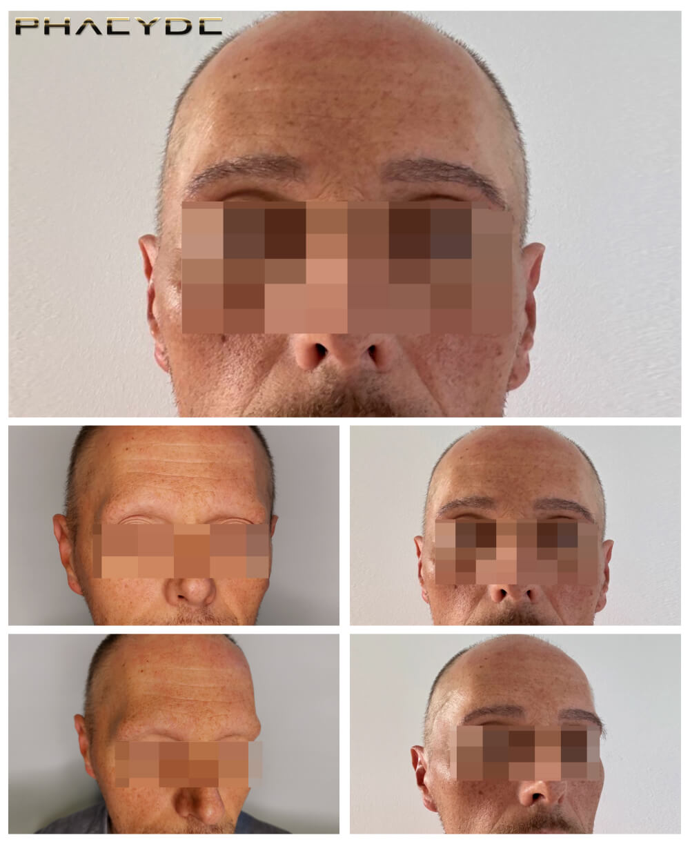 Transplantacja Brwi Ceny