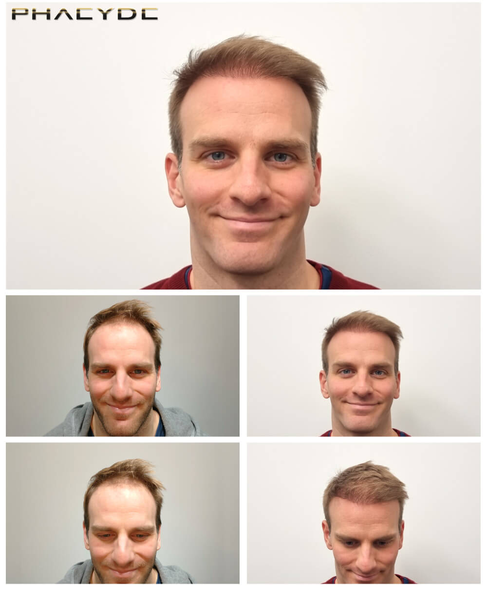 Lénárd – 1800 Przeszczepów