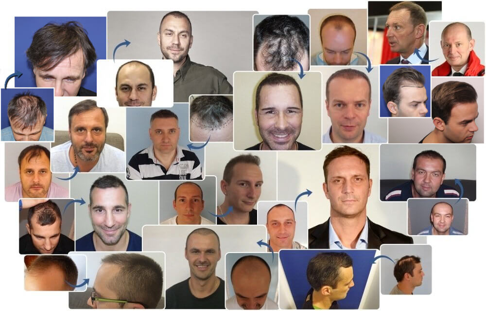 Hair Transplantation Banner